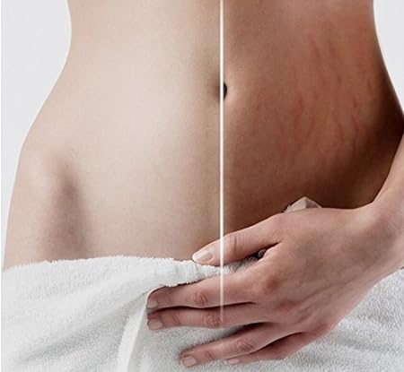 Crema para estrías y eliminación de cicatrices potente para estrías maternidad de la piel Crema Reparación de carrocerías, quitar cicatrices cuidado postparto